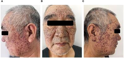 Efgartigimod-associated Kaposi’s varicelliform eruption and herpetic conjunctivitis in a patient with seropositive ocular myasthenia gravis: a case report and review